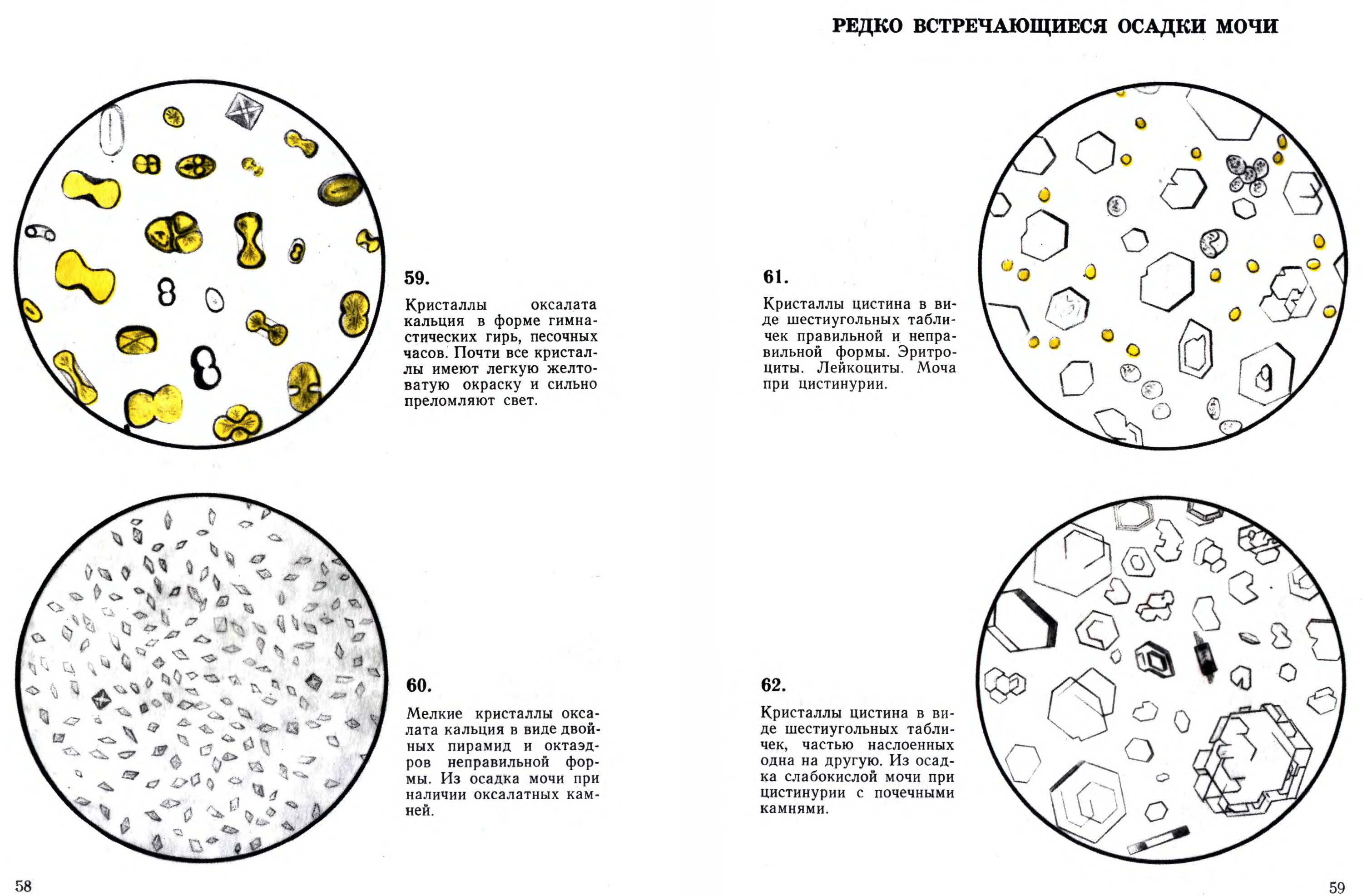 Осадки мочи. Микроскопия мочи осадка мочи атлас. Микроскопии осадков мочи Краевский в.я. Микроскопия осадка мочи атлас. Атлас микроскопии осадков мочи эпителий.