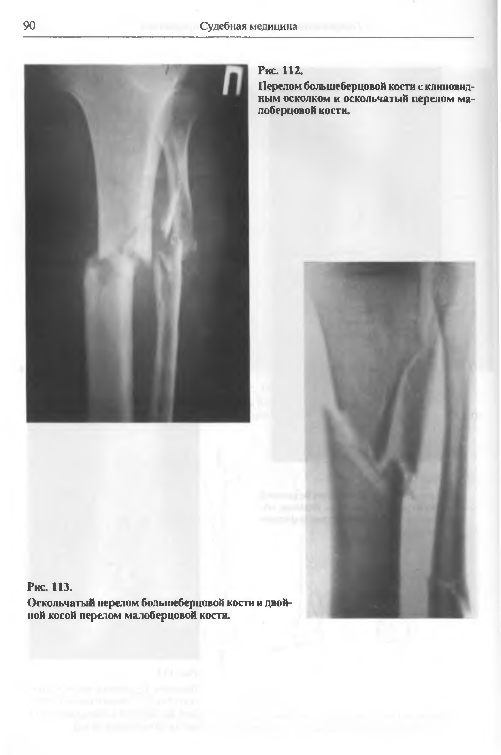 Многооскольчатый перелом большеберцовой кости рентген